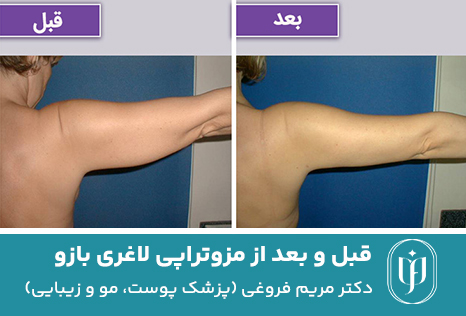 قبل-و-بعد-از-مزوتراپی-لاغری-بازو