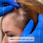 درمان-ریزش-موی-سکه-ای-در-اصفهان
