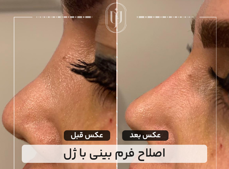 اصلاح-فرم-بینی-با-ژل