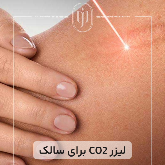 لیزر-CO2-برای-سالک