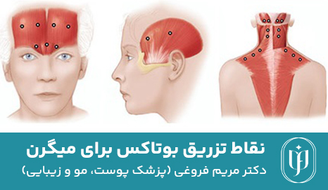 نقاط-تزریق-بوتاکس-برای-میگرن