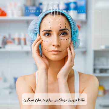 نقاط-تزریق-بوتاکس-برای-درمان-میگرن