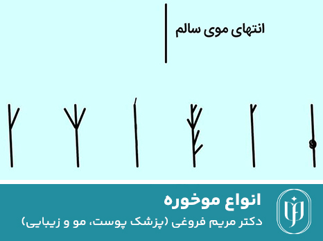 انواع-موخوره